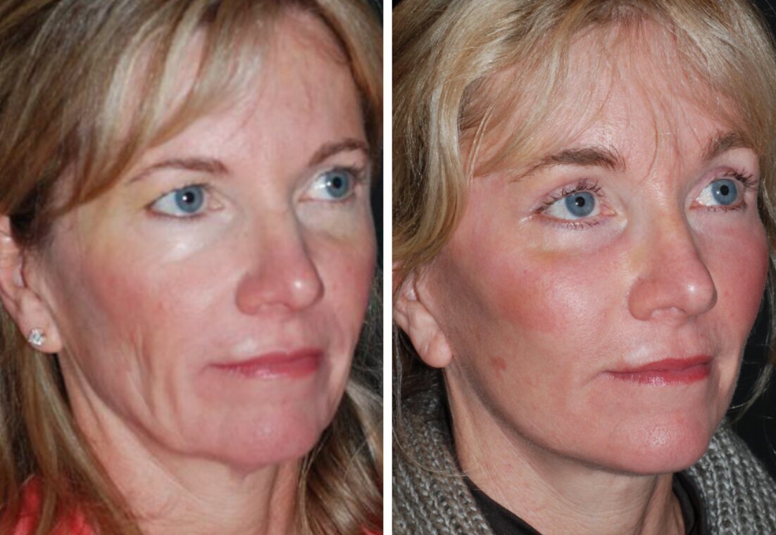 non-invasive treatments for lax skin neck glp-1 weight loss 4 Best Treatments for Loose Neck Skin After Weight Loss: Cost, Results &  Pictures