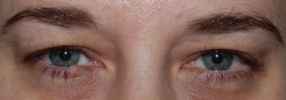 Eyelid Lift Before & After Image