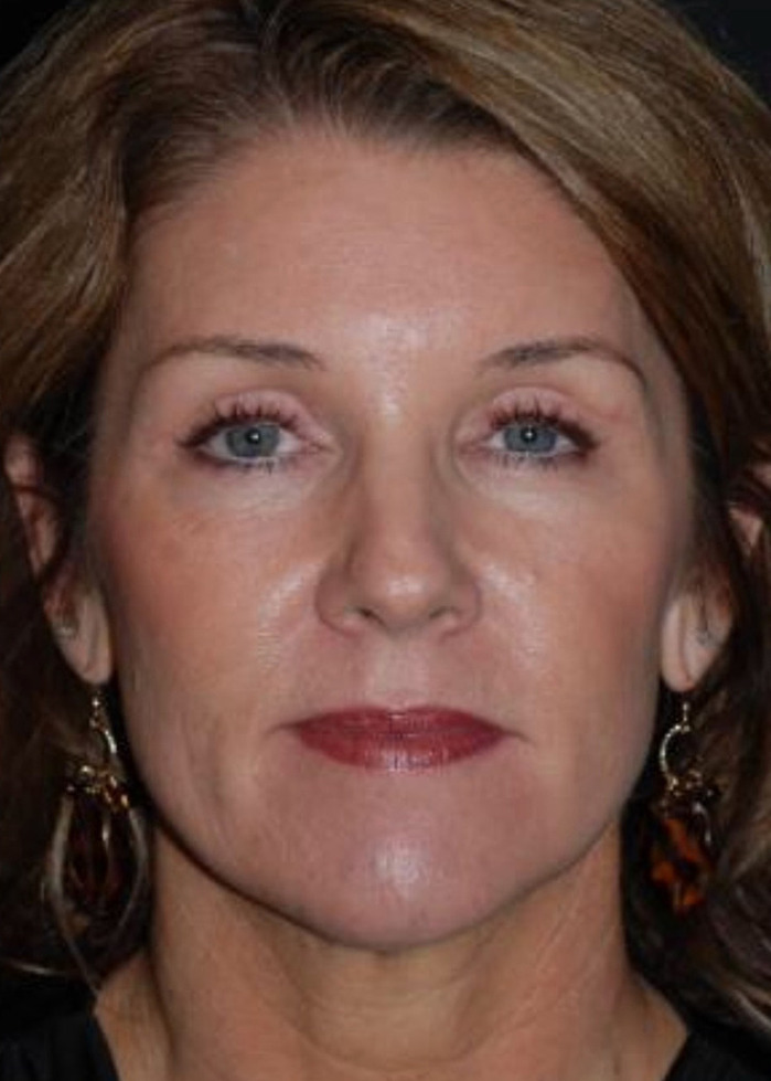 Cheek Lift Before & After Image