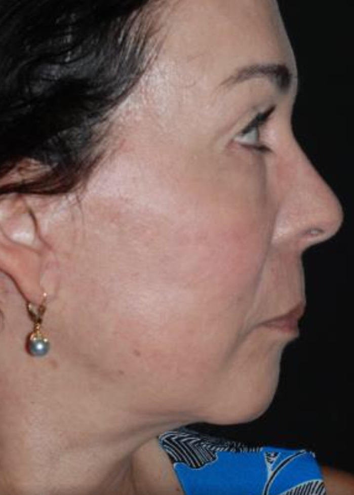 Deep Plane Neck Lift Before & After Image