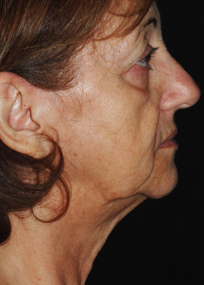 Deep Plane Neck Lift Before & After Image
