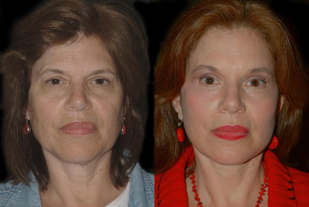Laser Resurfacing Before & After Image