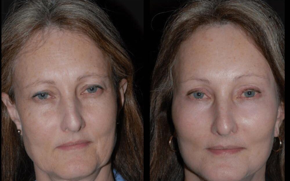 Laser Resurfacing Before & After Image